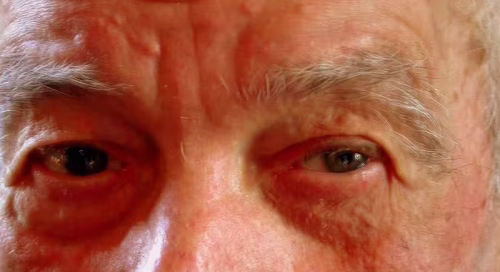 Die Augen eines alten Mannes als Symbol für Sehstörungen im Alter